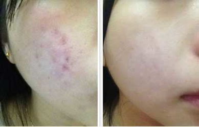 脸上狂长痘痘怎么回事,脸上长痘痘有什么办法彻底解决