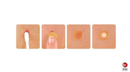 痘痘贴对痘坑有用吗,痘贴适用于什么痘痘