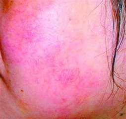 皮肤出现红血丝怎样修复,皮肤薄有红血丝有什么办法缓解