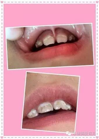 乳牙掉了没牙根怎么补牙,儿童乳牙龋齿烂了有必要补牙吗