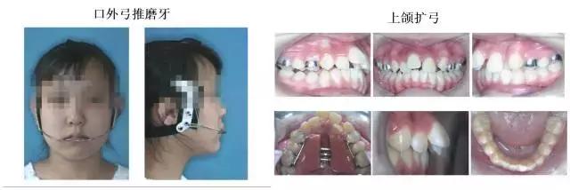 牙齿矫正是拔牙多好还是少好,为什么牙齿矫正一般都要拔牙