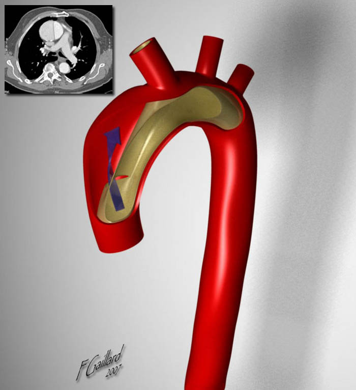 美国治疗主动脉夹层,倪海厦治疗主动脉夹层