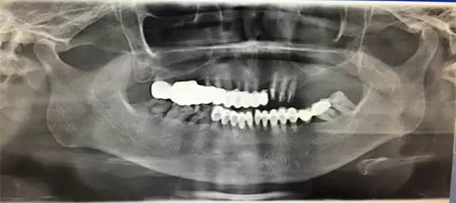 即使你放弃了牙齿矫正，也万不能投进“美容冠”的火坑