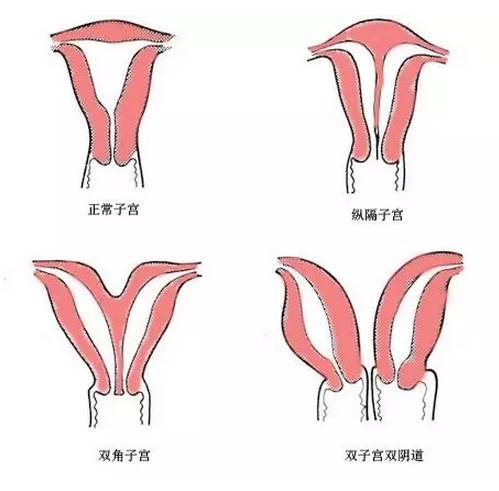 子宫也分“一室”和“二室”你不知道？