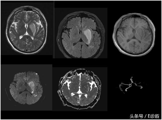 E诊断：脑梗塞影像图解