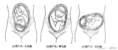 给你全面了解胎位知识，帮助选择分娩方式（上篇）
