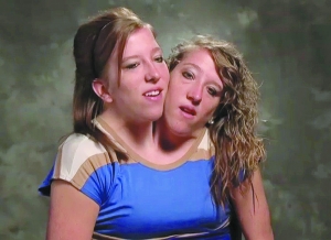 共用一个身体两个头的双胞胎,共用一个头的连体双胞胎女孩