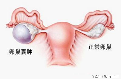 卵巢囊肿能引起月经不调和痛经吗,卵巢囊肿的病因病机