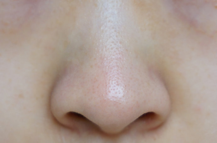 鼻子黑头毛孔粗大怎么收缩毛孔,鼻子毛孔粗大黑头怎么解决