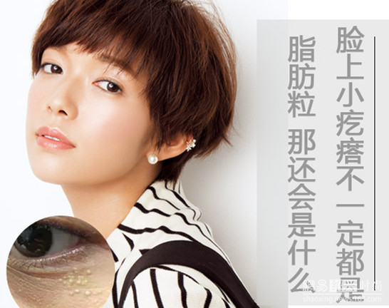 眼睛周围皮下的脂肪粒怎样去除啊,眼睛周围的扁平疣怎么消除脂肪粒