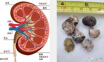爱跑厕所是膀胱小？输尿管短？