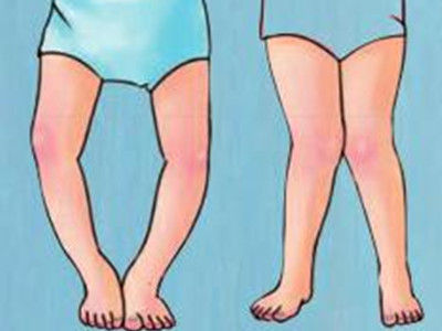 ox腿怎么矫正,ox腿怎么矫正男生