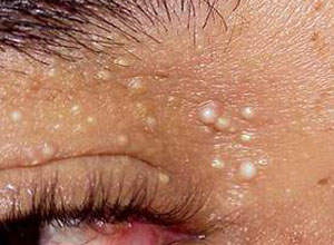 眼睛周围皮下的脂肪粒怎样去除啊,眼睛周围的扁平疣怎么消除脂肪粒