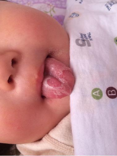 新生婴儿鹅口疮怎么回事,新生儿鹅口疮和正常对比