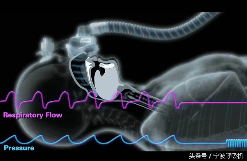 瑞思迈呼吸机真实测评,瑞思迈呼吸机用几年