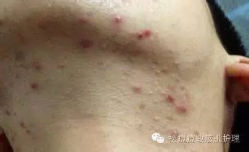 痘痘的形成和原因分析,痘痘形成的原因种类和处理方法