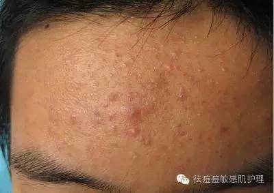 痘痘的形成和原因分析,痘痘形成的原因种类和处理方法