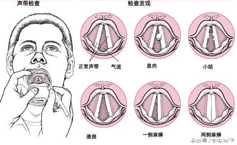 咽喉有囊肿会感觉有异物感吗,甲状腺囊肿喉咙异物感