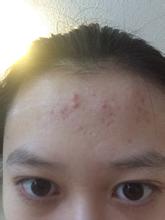 额头都是闭口痘痘怎么办,额头硬硬的痘痘怎么去掉