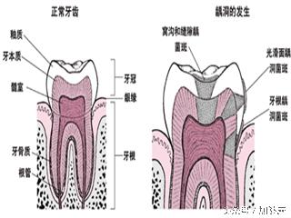 加健康收藏：有蛀牙？那就看看这篇文章吧