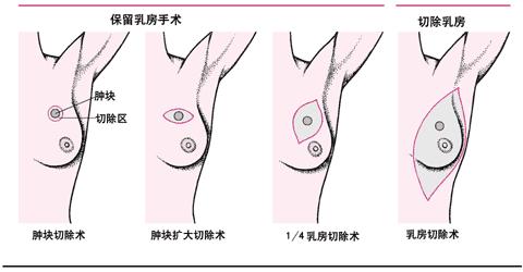 乳腺癌早期一般有6大征兆,乳腺癌早期十大的症状是什么