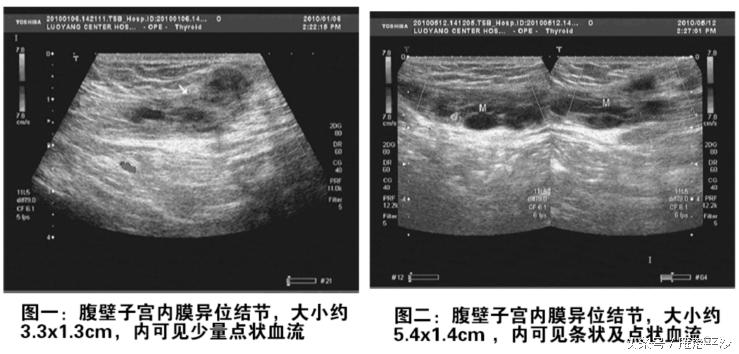 数年不孕的子宫内膜异位症姐妹终于好孕，分享中医调理经验