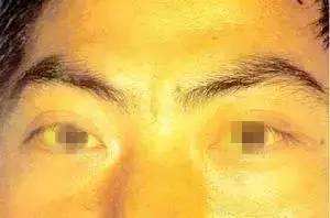 酒后肝脏部位隐隐作痛是怎么回事,酒后肝出现什么信号