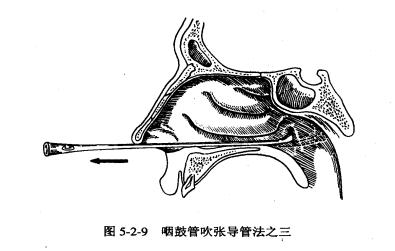 如何治疗分泌性中耳炎,分泌性中耳炎能自愈吗