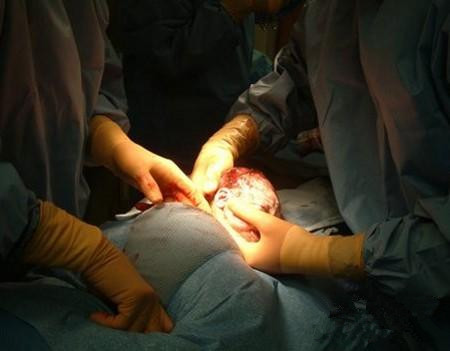 听说剖腹产更轻松？看看过来人怎么说！