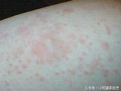 湿疹性皮炎中医辨证,小儿湿疹中医辨证