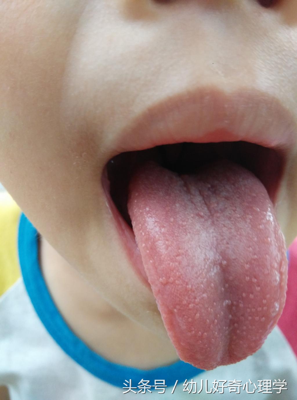 婴儿舌头底下血管发紫是怎么回事,婴幼儿舌头发黑是怎么回事