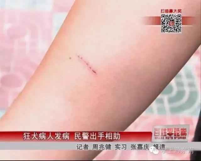 狂犬病医生在线咨询热线,狂犬病感染科医生咨询