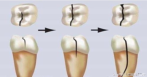 牙齿有小裂缝并且变黑,牙齿裂缝修复图片