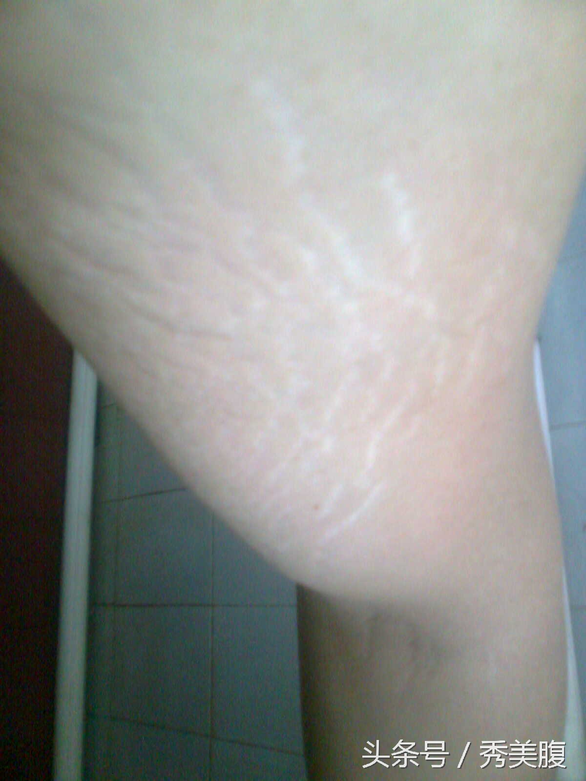 大腿内侧有红色的肥胖纹怎么减,大腿内侧肥胖纹皮肤变薄