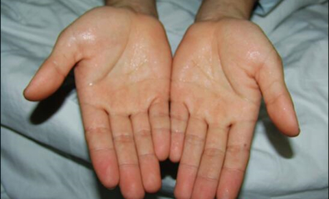 身体动不动就出汗头发油油的,动不动就出汗怕风怕冷怎么调理