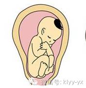 顺产胎儿是横位还是头位,分娩时胎头和骨盆关系