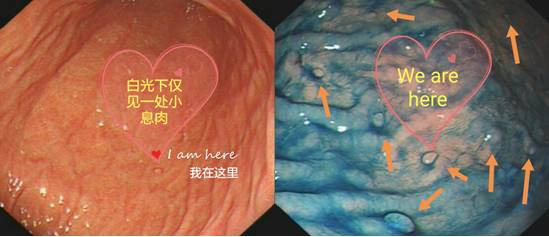 精细胃镜检查（二）——色素内镜（上）