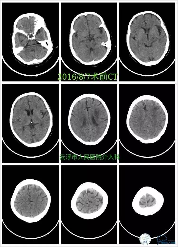 脑血管介入培训基地,脑卒中血管介入治疗