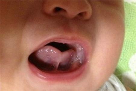 快看看你的宝宝长什么样,怎么判断宝宝舌头是否正常