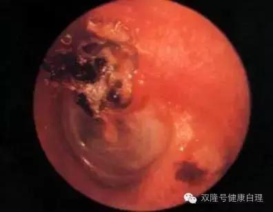 化脓性中耳炎,化脓性中耳炎清理