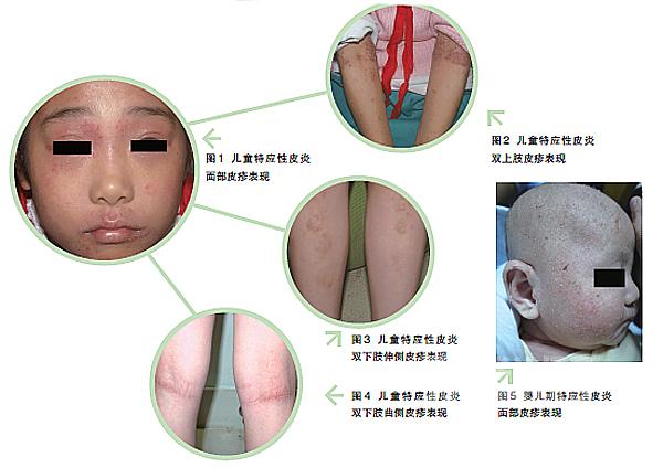孩子反复湿疹皮炎怎么回事,儿童湿疹久治不愈变成特异性皮炎