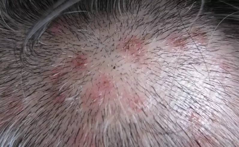 得了脂溢性皮炎会不会加重焦虑,得了脂溢性皮炎会有皱纹