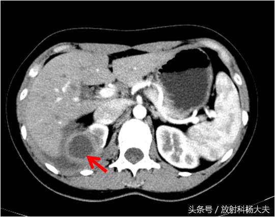 花季女孩背痛,青春期女生为什么总是腿痛