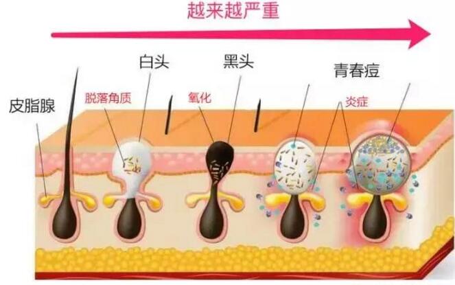 脸上粉刺黑头痘痘毛孔粗大怎么办,黑头闭口毛孔粗大一次性解决