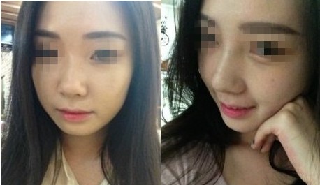 隆鼻太可怕怎么办,硅胶隆鼻正确方法图