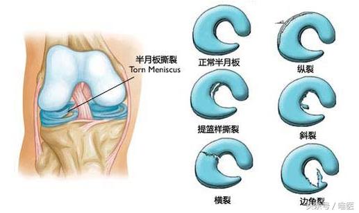 半月板撕裂微创手术术后恢复教程,半月板桶柄状撕裂修复缝合术