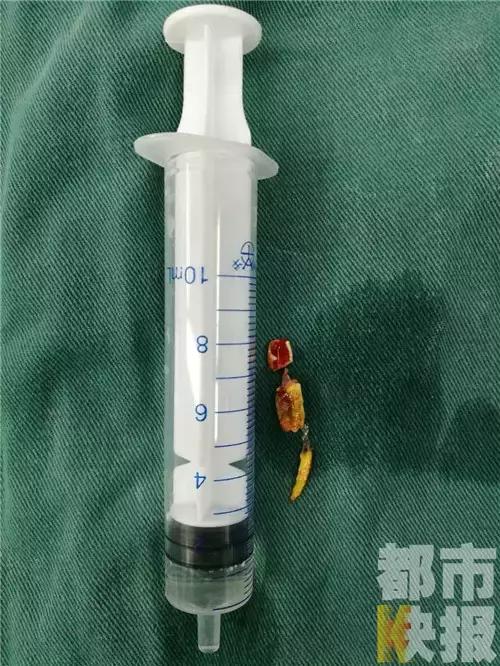 吃螃蟹要注意！商洛4岁男孩吃完它肺里竟出现这个