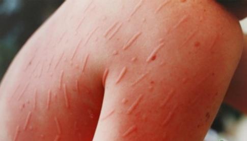 麻疹能治断根吗,麻疹治得好吗