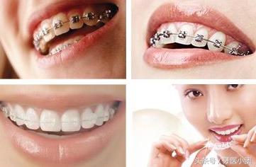 牙齿矫正换钢丝过程中很痛,牙齿矫正冲牙器会痛吗