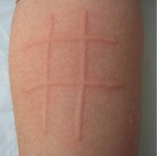 麻疹能治断根吗,麻疹治得好吗